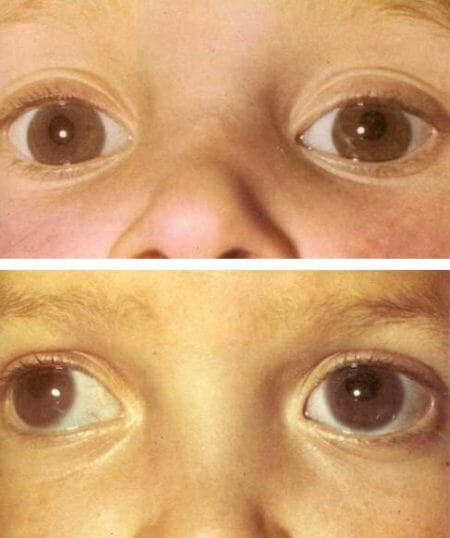 водянки глаза гидрофтальм у ребенка