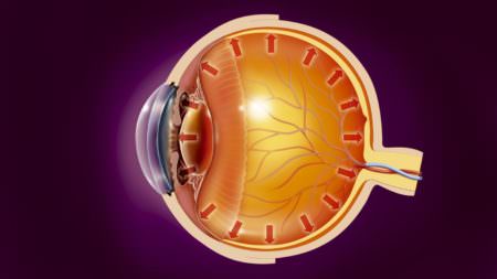 глаукома больной глаз