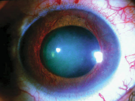 глаукома глаз больной