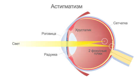 Схема глаза при астигматизме