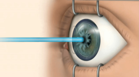 Лазерная коррекция глаз
