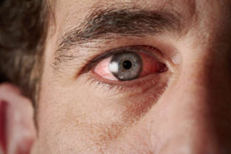 воспаленный глаз у мужчины