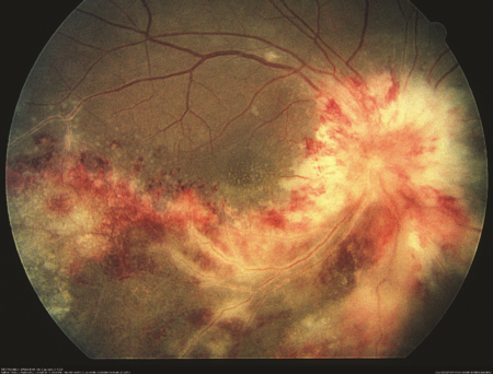 сетчатка при инфекционном ретините