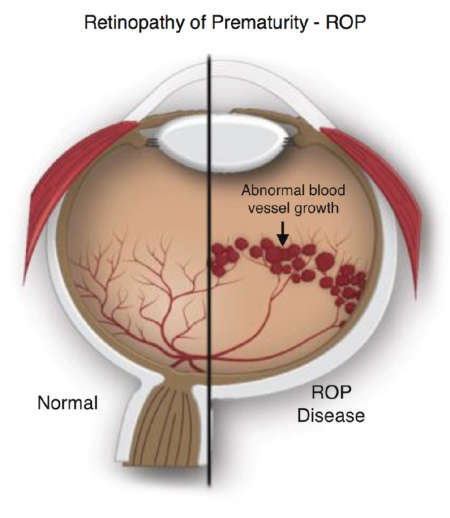 сравнение здорового глаза и с ретинопатией