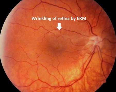 Эпиретинальная мембрана глаза 