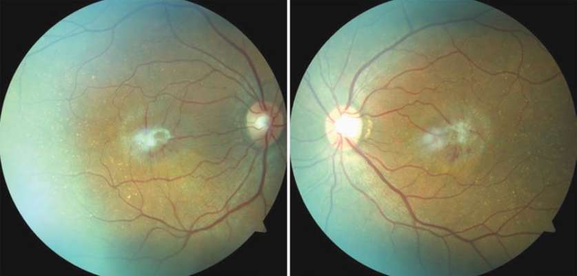 Эпиретинальная мембрана глаза: лечение или удаление?