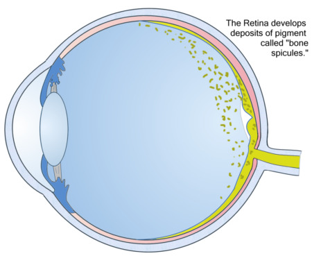 Пигментная дегенерация сетчатки глаза