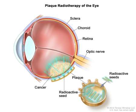 как выглядит ретинобластома