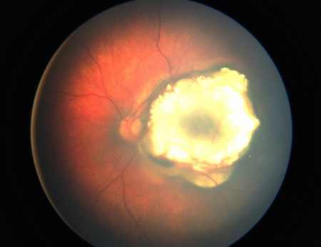 ретинобластома на снимке сетчатки
