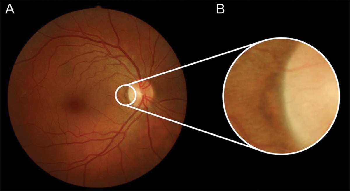 Офтальмоскопия линзой. Отслойка сетчатки офтальмоскопия. Отслойка сетчатки биомикроскопия. Центральная серозная ретинопатия. Отслойка сетчатки глазное дно.